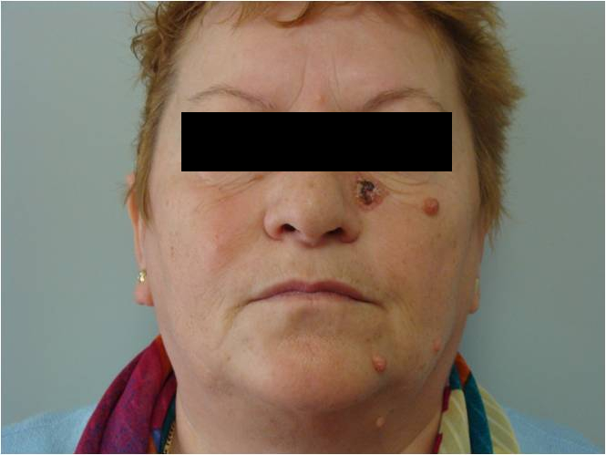 Basal cell carcinoma of the left cheek - after a year